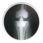 Revision Joint Replacement (Knee and Hip)
