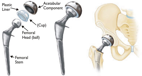 hip-repacement-orthonova-hospital-jalandhar